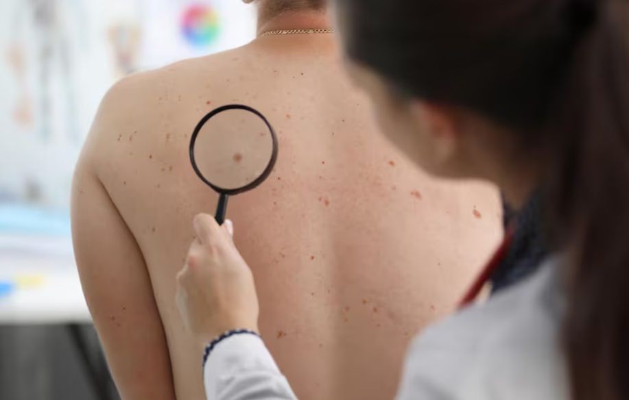 HISTÓRICO AVANCE CIENTÍFICO: UNA VACUNA CONTRA EL CÁNCER DE PIEL DA RESULTADOS POSITIVOS EN FASE 3
